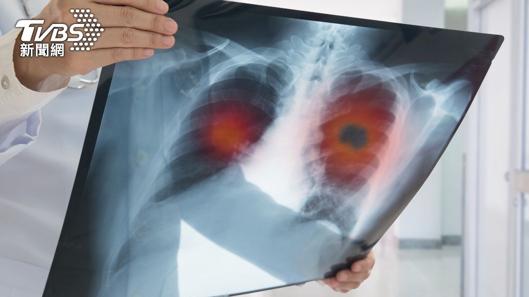 Lung cancer takes the lead on Taiwan’s cancer list in 2021(Shutterstock)