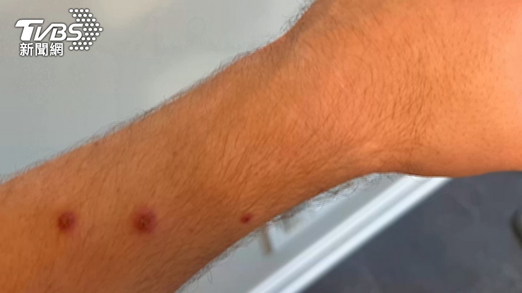 First monkeypox fatality case confirmed in Taiwan (TVBS News)