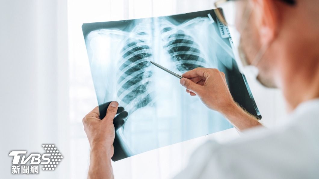 Lung cancer now leading cancer type in Taiwan (Shutterstock)