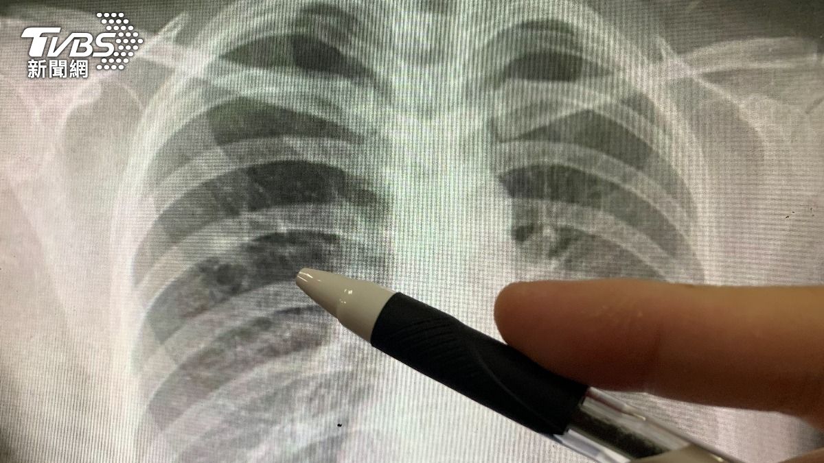 Cancer leads as Taiwan’s top cause of death in 2023 (TVBS News)