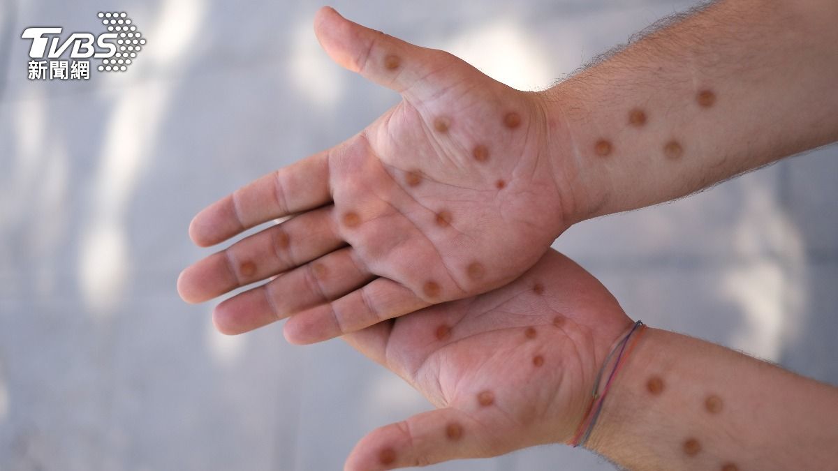 Taiwan health officials warn of summer mpox transmission risk (Shutterstock)