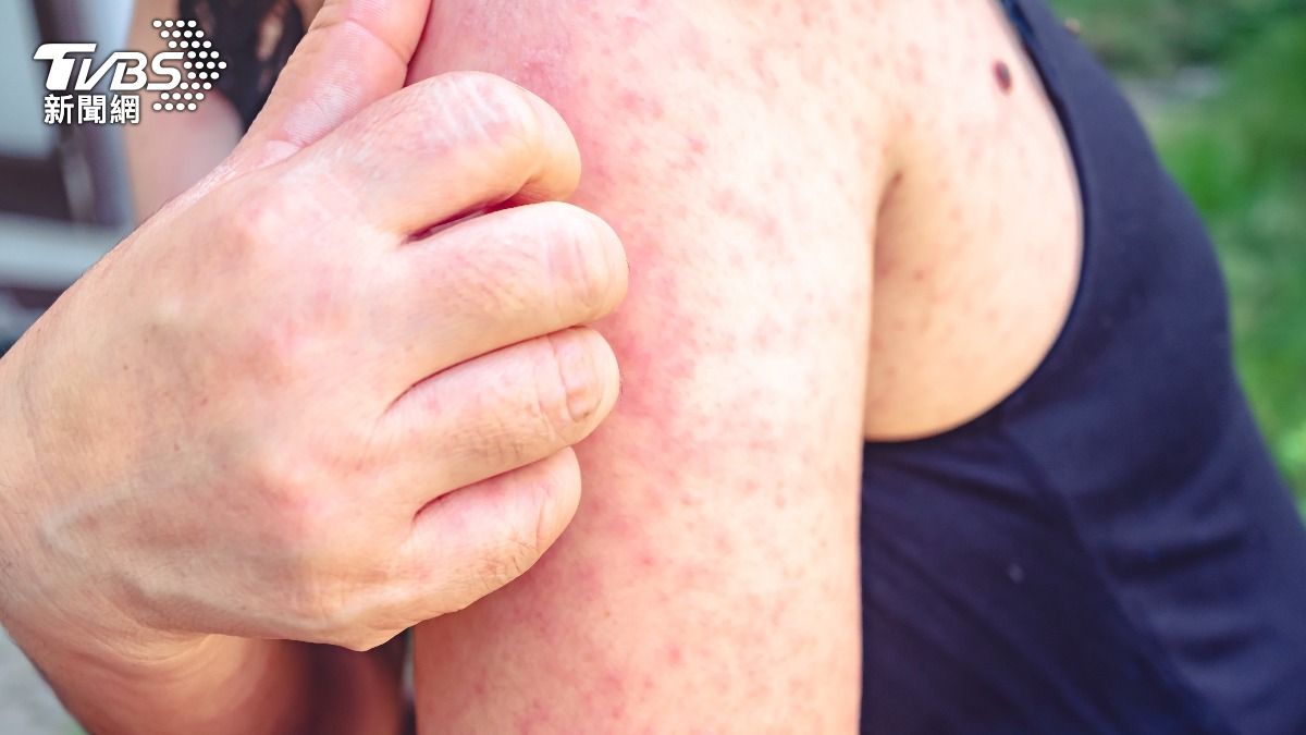 Kaohsiung health urges rail travelers to report measles (TVBS News)