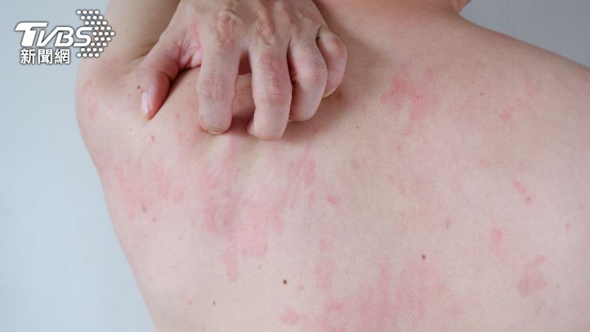 First LA measles case from Taiwan traveler (Shutterstock)
